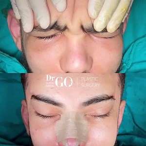 three-stage pentalift procedure on our male patient, which included a temporal lift, midface lift, and brow lift with revision rhinoplasty