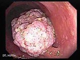 Large Tubulo-Villous Adenoma (6 of 6) • Video • MEDtube.net
