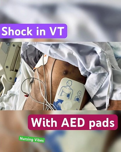 How To Give Shock With AED pads, #nursinginterview #hospital