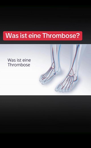Understanding Thrombosis and Pulmonary Embolism