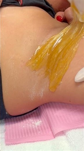 SUGAR WAX | SUGARING #sugaring #waxing #brazilianwax #hairremoval
