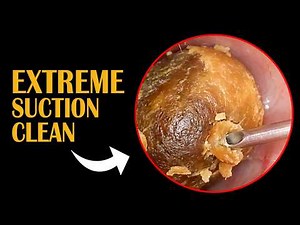 Testing the suction power of professional vacuum tools against thick stubborn earwax