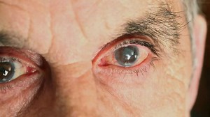 Glaucoma symptoms: 6 early signs you shouldn’t ignore and who is more at risk