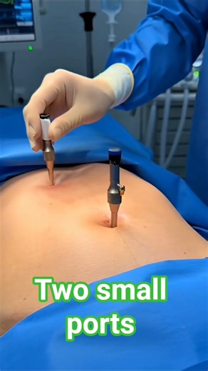 Two additional small ports placed #leproappendectom #health surgery with sami#port#torcarinter #