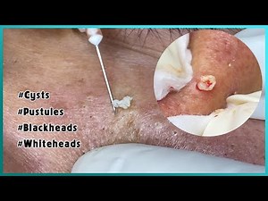 Big Cystic Acne Blackheads Extraction Blackheads & Milia, Whiteheads Removal Pimple Popping