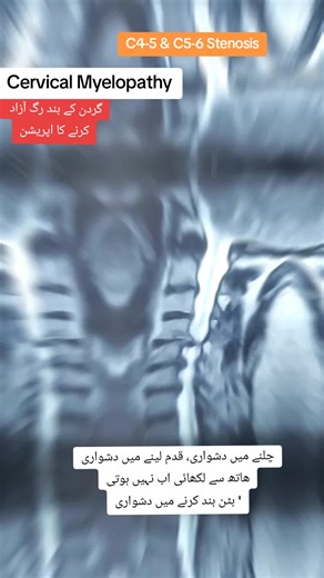 Cervical Myelopathy: Difficulty in Movement and Symptoms