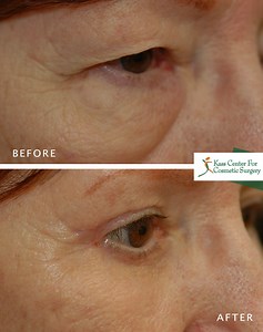 Festoon Malar Mounds Treatment St. Petersburg & Clearwater