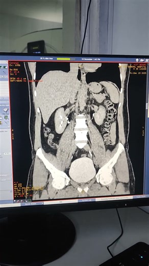 CT UROGRAM 3D RECONSTRUCTED IMAGES..#ctscan #3dimages #siemens #radiology