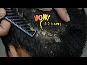 Psoriasis Scalp Scratching Big Flakes #1182