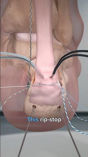 MIS FiberTak® Achilles SpeedBridge™ System Product Demonstration
