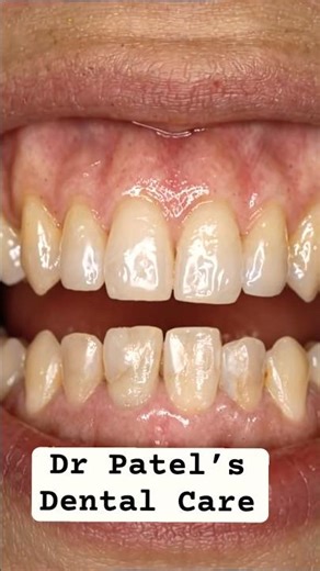 Ugly Chipped Front Tooth Filling?😬Watch ThiSmile Transformation|Instant Confidence Boost #trending