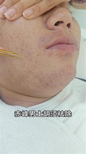 大胡子怎么刮都刮不干净，赤峰男士胡须根除#赤峰男士胡须根除