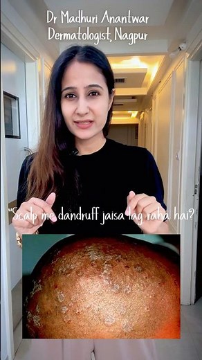 Fungal infection: itchy scalp ,scalp fungal !