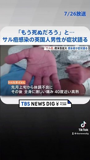 「もう死ぬだろう」と…40度近い高熱、鼻や手足に発疹 サル痘感染の英国人男性が症状語る #shorts | TBS NEWS DIG