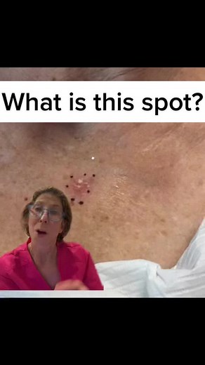 Understanding Basal Cell Carcinomas: What You Need to Know