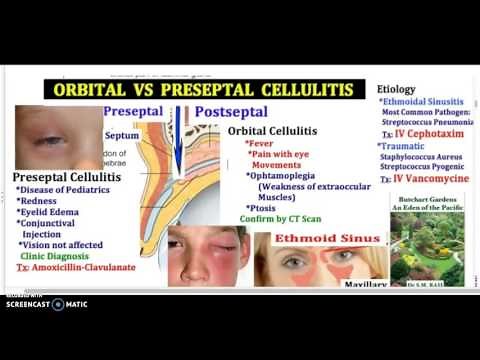 ORBITAL VS PRESEPTAL CELLULITIS USMLE I MCAT I Pediatric in 3 minutes