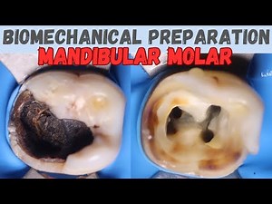 Biomechanical Preparation in Mandibular Molar  • Video • MEDtube.net
