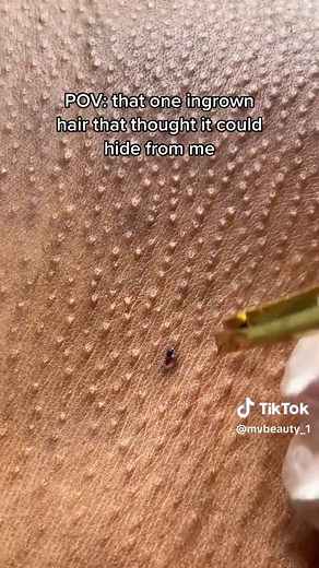 Effective Ingrown Hair Removal Techniques