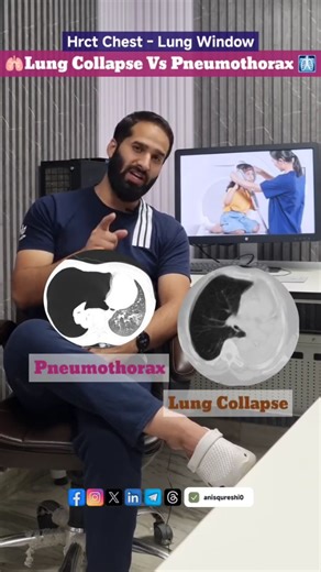 Anis Qureshi 🍁 on Instagram: "Lung Collapse vs Pneumothorax – Don’t Get Confused Know the difference in seconds 👇 HRCT ChEST 🔹 Lung Collapse (Atelectasis) ✔️ Hyperdense lung ✔️ Volume loss ✔️ Mediastinal shift toward lesion 🔹 Pneumothorax ✔️ Hypodense (air density) ✔️ Visible pleural line ✔️ No lung markings beyond ✔️ Mediastinal shift away (if tension) 📌 Exam-oriented | Concept-based | Easy to remember Save & share with your radiology friends 🔁 #HRCTChest #Radiology #RadiologyReels #XRayT