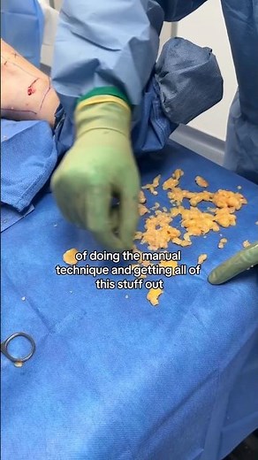 Manual Lipedema Extraction™ is a transforming experience to treat #LIPEDEMA 💜