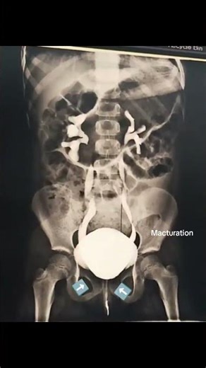 Procedure MCUG #viral #anatomy #humanbody #yt #hospital #urinarybladder #urinarytract #doctor #short