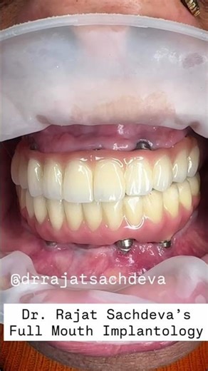 Full Mouth Dental Implants Before & After | Complete Smile Transformation | Dr Rajat Sachdeva