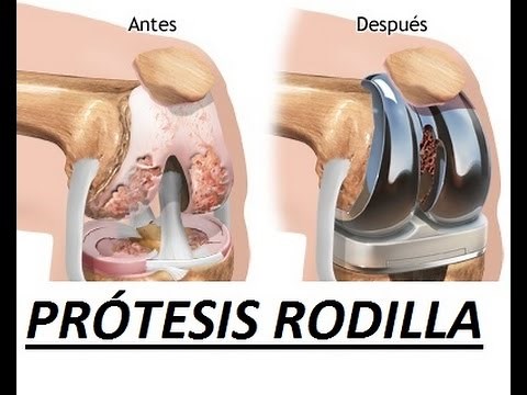 PRÓTESIS DE RODILLA: Qué son, los tipos qué hay y los objetivos de la reeducación