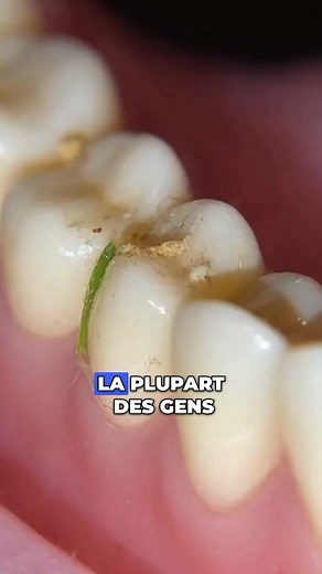 Vous utilisez encore des comprimés pour nettoyer votre dentier ? Le problème, c’est qu’ils masquent l’odeur, mais ne suppriment pas les bactéries. Résultat : mauvaise haleine, gencives irritées et dentier qui jaunit. Avec Dentaclean, il suffit d’appuyer sur un bouton : en 3 minutes, les ultrasons éliminent 99,9 % des bactéries et laissent votre prothèse éclatante, sans effort. Un geste simple pour un dentier propre, frais et confortable chaque jour. | Lyra | Facebook
