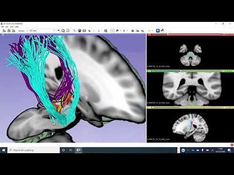 Sensory and motor pathways and lacunar infarcts using diffusion MRI data