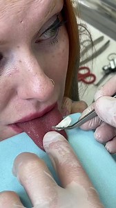 35K views · 186 reactions | Womens tongue has a material removed...