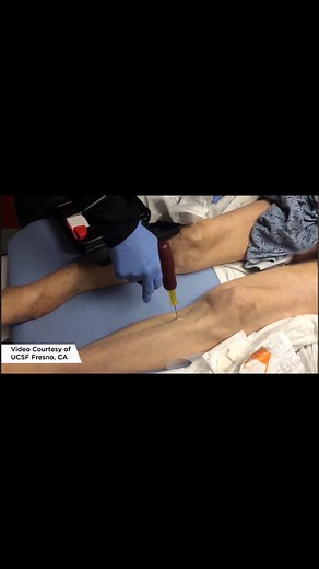 Punção Intra-óssea e Proximal Tibia - Guia Completo