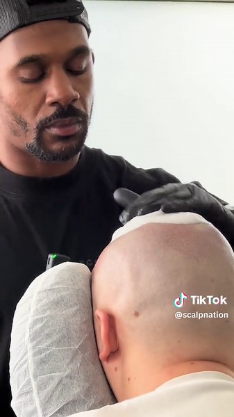 Scalp Micropigmentation: The Ultimate Hair Loss Solution