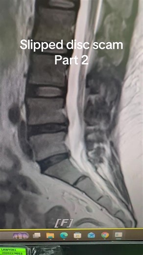 Understanding Slipped Disc: Causes and Treatments