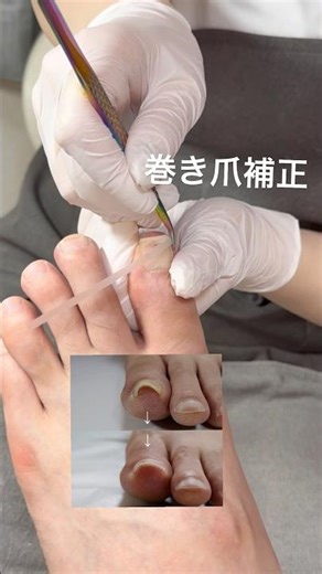 巻き爪補正 新しい技術、柔らかいプレートを使用してるから痛みもなく自然な仕上がり#巻き爪ケア #フレックスプレート #巻き爪矯正