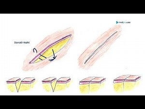 Donati Suture | Basic surgical techniques