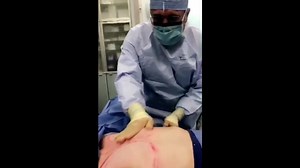 Male Breast Reduction with Ultrasonic Liposuction (GRAPHIC)