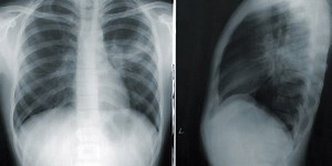 Dangerous fungal illness rapidly spreading across country, doctors warn