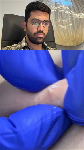 This Tiny Opening Led to a Big Surprise #cyst #cystpopping #cystremoval