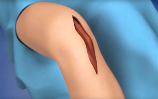 3D视频演示人工膝关节置换过程！