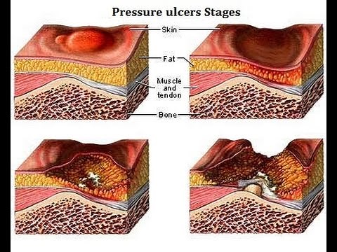 Pressure ulcers stages 1, 2, 3 and 4
