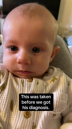 Understanding Moebius Syndrome: A Personal Journey