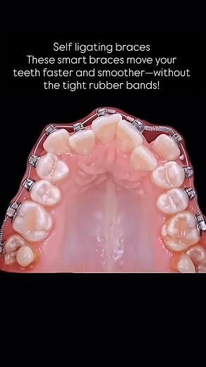 Dr Parijat Pallav M.D.S. | Watch how these smart self-ligating braces move teeth effortlessly 😎🦷 Faster, smoother, and way more comfortable! #BracesJourney... | Instagram