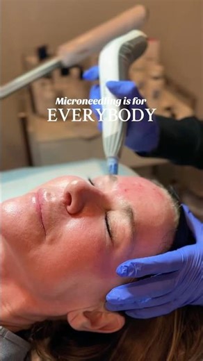 Transform Your Skin with Microneedling! ✨