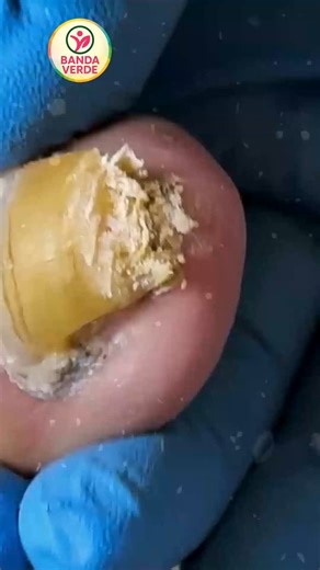 Safe Routines to Prevent Calluses and Cracks for Busy Adults 🍎🍅 #SafeNailCare #HomeNailCare #NailFixTips | Banda Verde