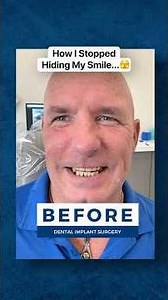 Do Dental Implants Make You Look Younger? 👀