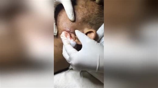 Horrifying moment enormous zit on man's face is popped