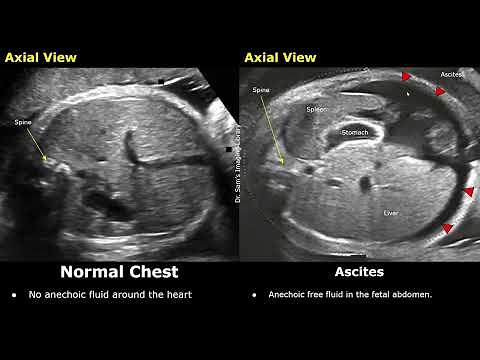 Obstetric Ultrasound Normal Vs Fetal Hydrops | Pericardial, Pleural Effusions, Ascites & Skin Edema