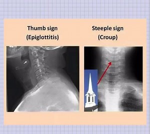 774K views · 12K reactions | 1/meniscus sign 2/air fluid level 3/silhouette sign 4/steeple sign croup 5/thumb sign epiglottitis د.كمال | تعليم الأشعة العادية - أشرف الشاعر | Facebook