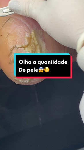 Tratamento de Unhas e Alívio com Podologia