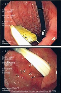Endoscopic foreign body retrieval - Alchetron, the free social encyclopedia